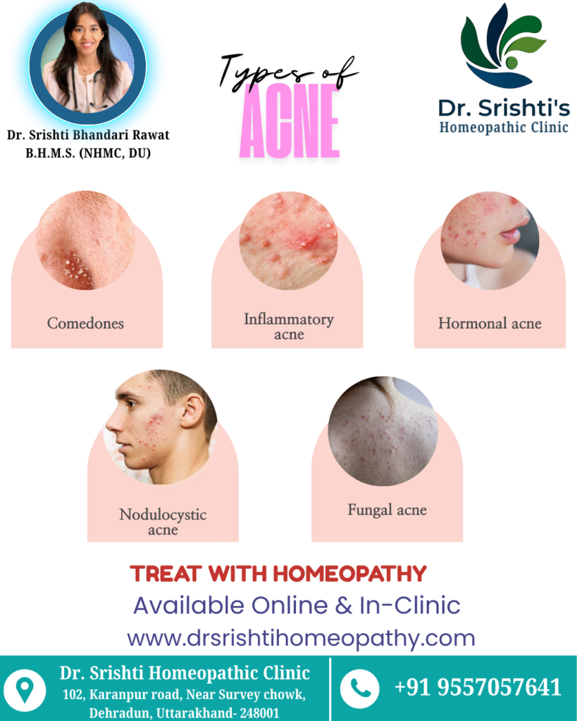 Acne treatment homeopathy dehradun 